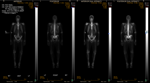 4 bone scans